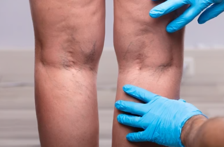 Close up of a doctor examining the varicose veins on the back of a patients leg in need of treatment